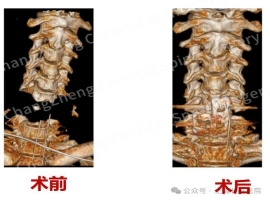 我国医务人员成功实施救治，挽救一例极其罕见的“头部与身体分离”病例。-小胖资源分享网