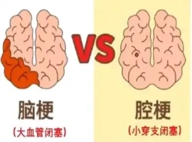遗憾的是，一位年龄超过45岁的三甲医院脑梗治疗领域专家不幸患上了脑梗。-小胖资源分享网