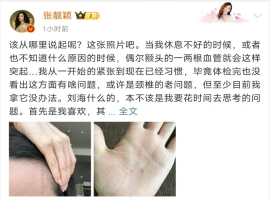张靓颖透露，近期健康体检结果显示她存在营养不良问题：她的手部皮肤出现了出血现象。-小胖资源分享网